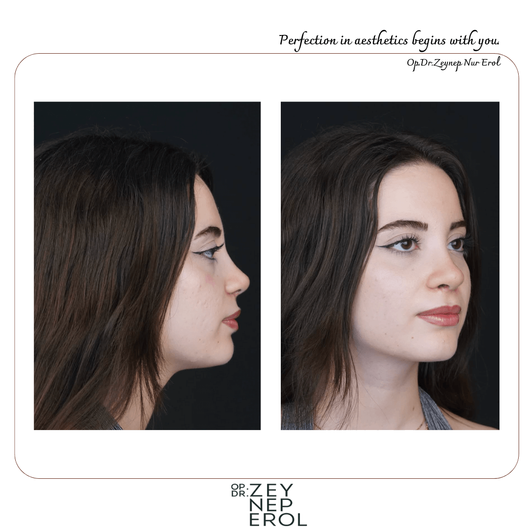 Esthétique du nez - Rhinoplastie